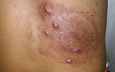 Yeast infection symptoms cracked skin